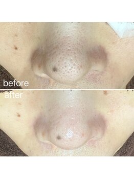 エクラ バイ シャンリィ(eclat by shanLy)/毛穴洗浄は早いうちに!