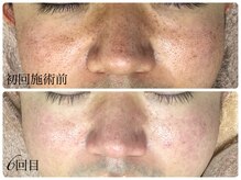 シェミー(CHEZ MEE)/【メンズ美容】毛穴/美肌/肌管理