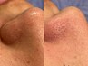 【レディース限定】美眉アイブロウWAX＋お顔のワンポイントWAX脱毛 4980円