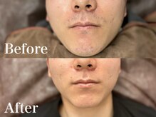 ボス 岡崎店(BOSS)/【顔脱毛/ヒゲ脱毛】鼻下　#脱毛