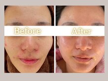 ハル(HARU.)/大人の肌荒れニキビケア