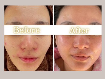 ハル(HARU.)/大人の肌荒れニキビケア