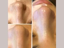 セリジェ 青山(Cerisier)/毛穴ケアと角質ケアが一気に☆