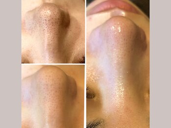 セリジェ 青山(Cerisier)/毛穴ケアと角質ケアが一気に☆
