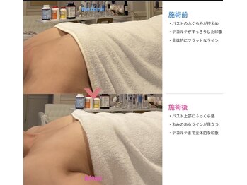 ブエナイン(Buenaine)の写真/わずか1回でバストUP！横に流れたバストの脂肪を戻す・姿勢改善で位置UP・ 巡り改善でふっくら