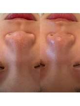 モア 吉祥寺(MORE.)/毛穴洗浄Before after