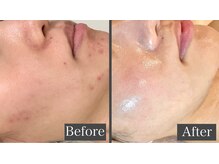 ルヴィカカリーナ(REVI Cacalena)の雰囲気（しつこい肌荒れも撃退◎肌質改善でお肌の内側からツヤツヤ陶器肌）
