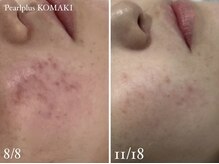 パールプラス 小牧店(Pearl plus)/BeforeAfter