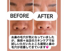 肌質改善白玉スノーピールで眉間、鼻の毛穴もスッキリ！