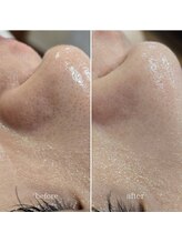 イチグラム(Ichi Glam)/ハーブピーリング効果