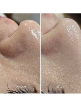 イチグラム(Ichi Glam)/ハーブピーリング効果