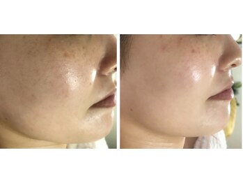 アルページュ(Arpege)/シミケア２０分×白雪アンプル♪