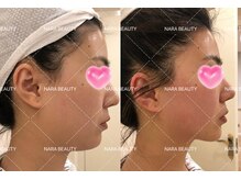 ナラビューティー(NARA BEAUTY)/韓国最新オンタリフト導入！