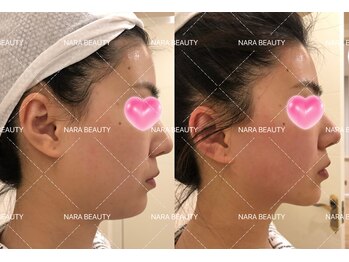 ナラビューティー(NARA BEAUTY)/韓国最新オンタリフト導入!