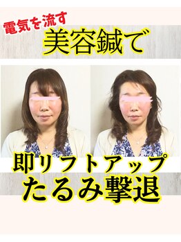 美容鍼＆首肩こり骨盤整体サロン ひふね/40代 美容鍼 Before/After