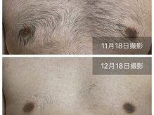 【男性全身脱毛】１回の施術でこの効果です♪