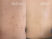 ルーム(lume)/背中のハーブピーリング