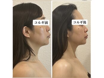 アバティック(ABatick)/小顔矯正コルギ　効果