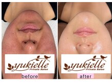 ユキエル(yukielle)の雰囲気（第4世代韓国LHAピーリング“セラピール”正規取扱サロン）