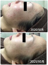 ビエル(Bielle)/大丈夫！アクネケアで肌改善する