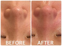 ハーブピーリング 恵比寿/小鼻の角栓/毛穴引締め