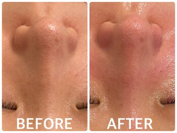 ハーブピーリング 恵比寿/小鼻の角栓/毛穴引締め