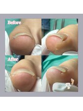 巻き爪補正店 天王寺店/お子様のお爪も巻き爪に！？