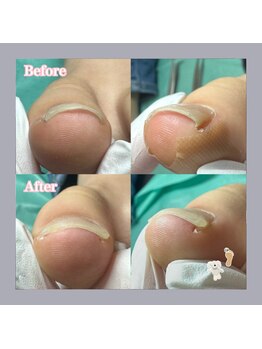 巻き爪補正店 天王寺店/お子様のお爪も巻き爪に!?
