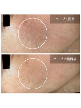 ラペ(la paix)/フェイシャル症例/40代