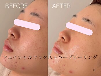 ケアズ(CARES)/ワックス＋ハーブピーリング