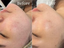 エジラランテ(esilarante)/REVI　ハーブピーリング