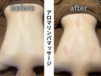 介正鍼灸整骨院 整体院 エフコープ大野城店/アロマリンパ＊ビフォーアフター