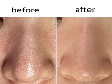 KMB 中崎町店/毛穴洗浄