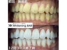 ホワイトニングバー アティ郡山店/12回コース終了ビフォーアフター