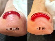 ネイルサロン マリア(nail salon Maria)/巻き爪改善2本付+FOOTワンカラー