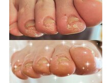 アベビー(Abeby)/つま先の角質