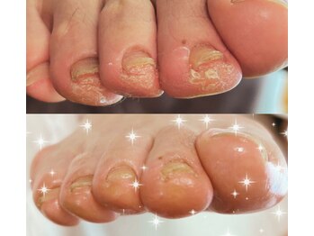 アベビー(Abeby)/つま先の角質