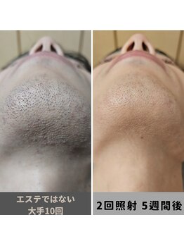 キムラケ 和光別邸(木村家 KIMURAKE)/大手他社比較　メンズ脱毛ヒゲ