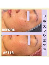 アールアンドエス(R&S)/プラズマシミケア