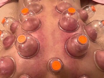 スイクウ ネオ(neo)の写真/【完全貸切】本場のカッピングを熟練の技術で！疲れ・重だるさ・むくみ…全部まとめてカッピングで巡り出す