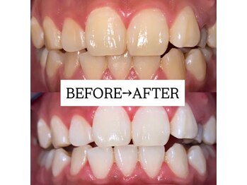 ホワイトニングサロン 宝塚/Before&After美白ホワイトニング