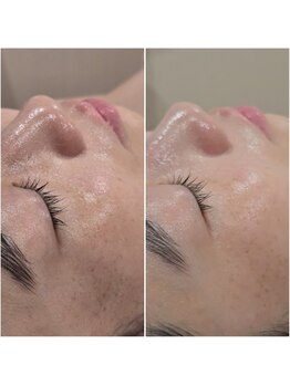 イチグラム(Ichi Glam)/美白トリートメント効果