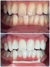 エクシアホワイトニング 町田店/ホワイトニングビフォーアフター