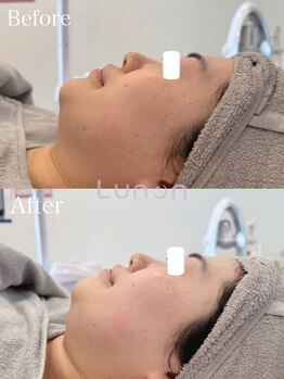 ルノン(Lunon)/毛穴洗浄ハイドロ