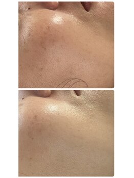 白の雫/毛穴洗浄 当日の変化