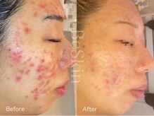 ビースキン 藤沢店(BeSkin)/皮膚科に行っても困っていた