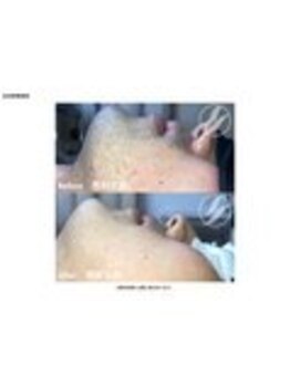 メンズ脱毛ダイアナ 松江店/青ひげ改善