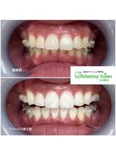 ホワイトニングサロン 名古屋駅店/【ホワイトニング施術例】