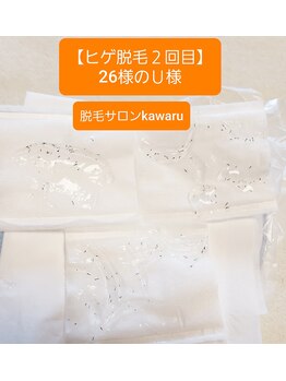 カワル(kawaru)/《ヒゲ脱毛２回目のお客様》