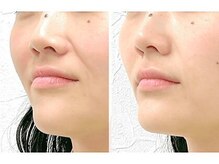 ビハリスト 麻布十番の雰囲気（術後の効果&効果が長続きする美容鍼が当院の特徴【美容鍼】）
